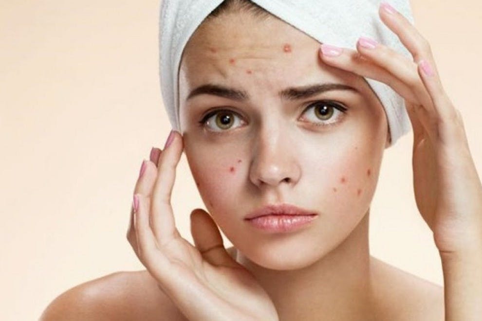 Existen remedios caseros naturales para reducir la aparición del acné.