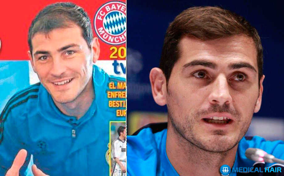 Íker Casillas trasplante de pelo