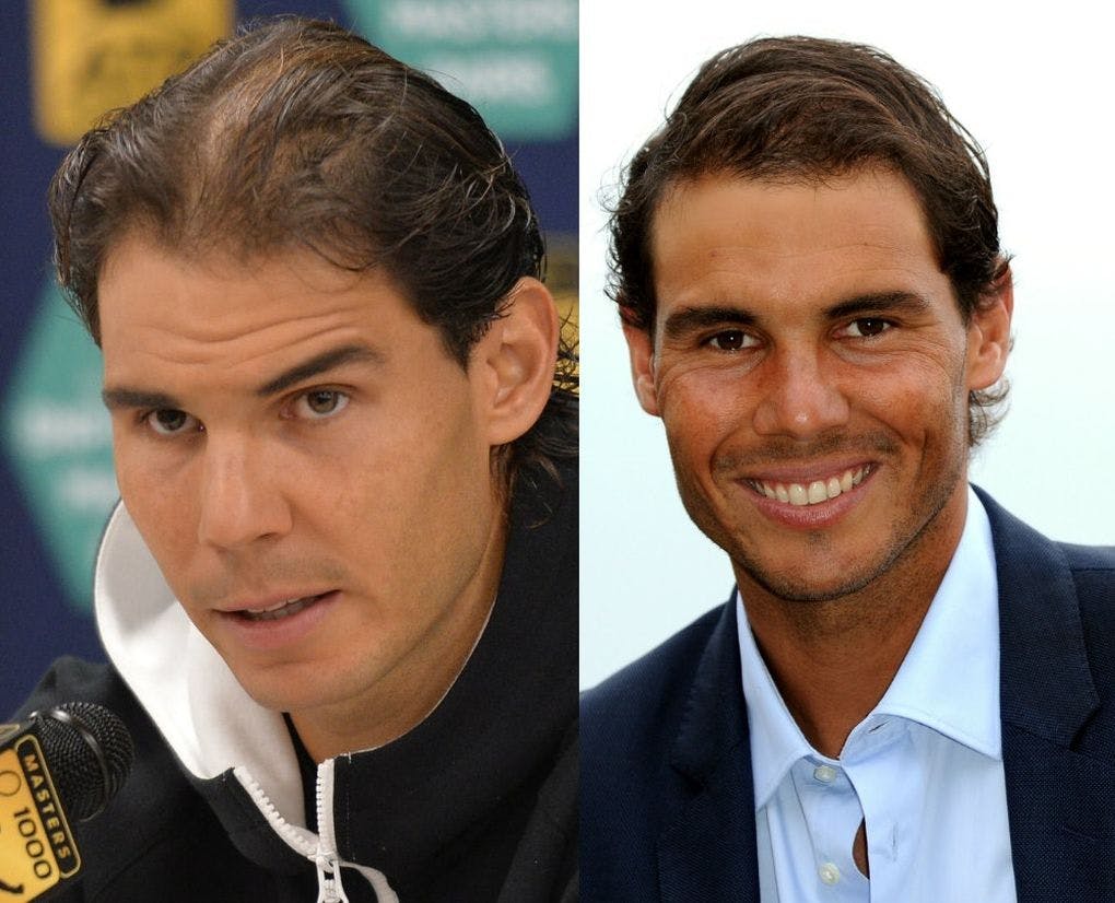 Rafael Nadal trasplante de pelo