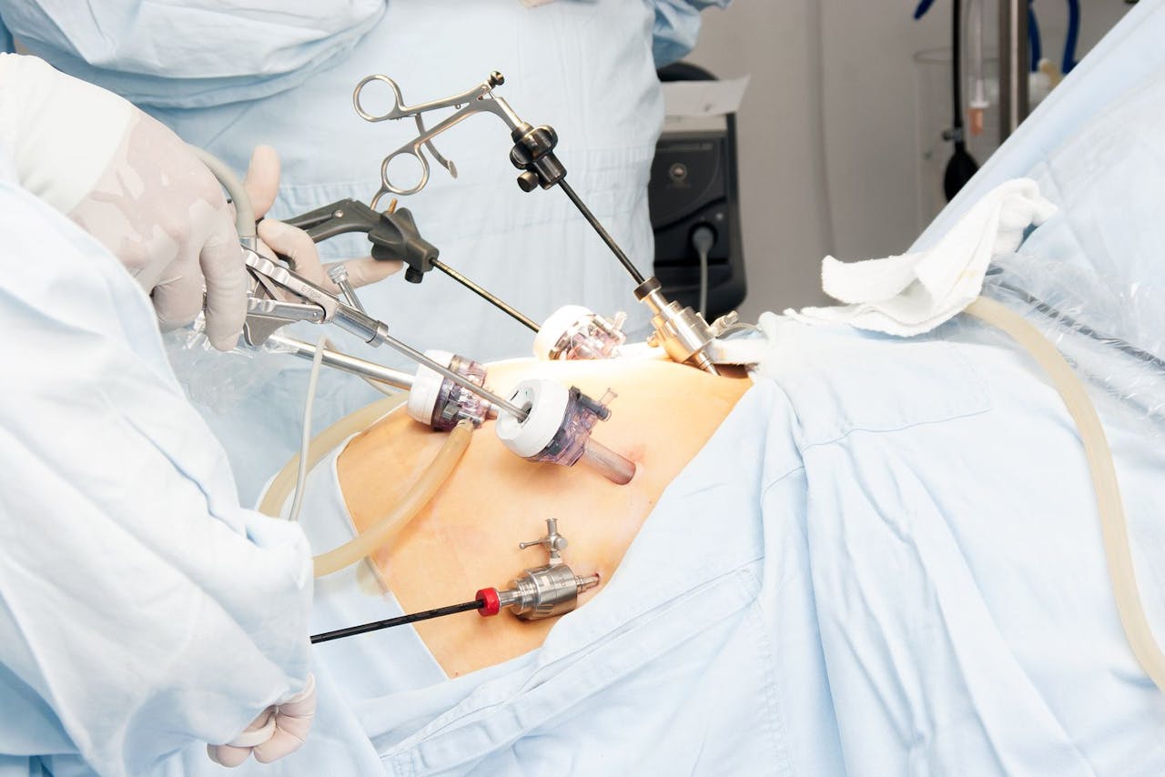 Cirugía bariátrica operación