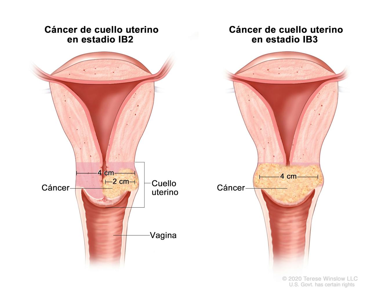 Qué es cáncer cuello uterino